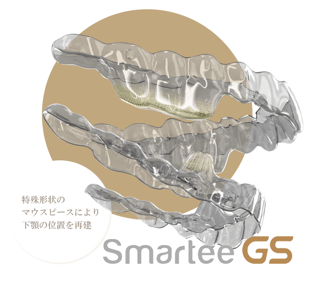 SmarteeGS（スマーティーGS矯正） マウスピース矯正
