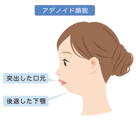 アデノイド顔貌
