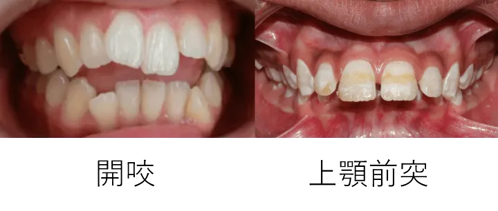 開咬・上顎前突