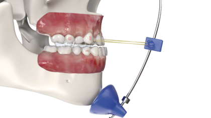 Smartee Sulution(S16)