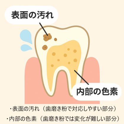 歯の表面の汚れと内部の着色