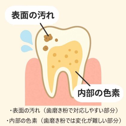 歯の表面と内部の汚れ
