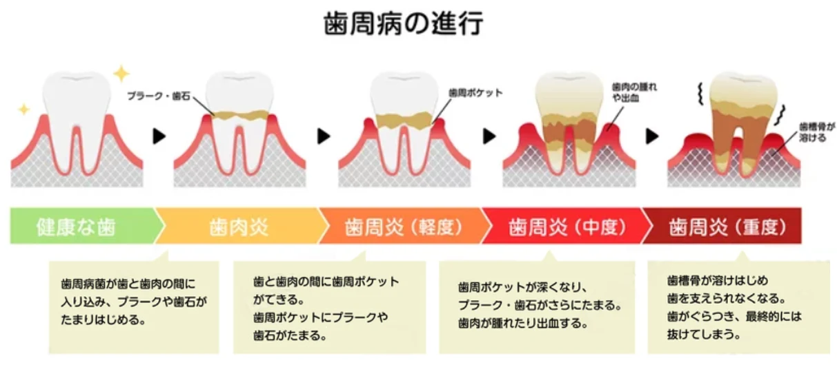 歯周病の進行