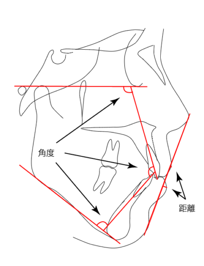 セファロ歯性・Eライン