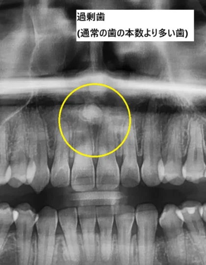 過剰歯