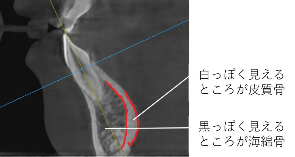 下の顎の前歯のCBCT断面の画像