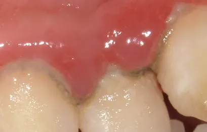 赤く腫れた歯茎