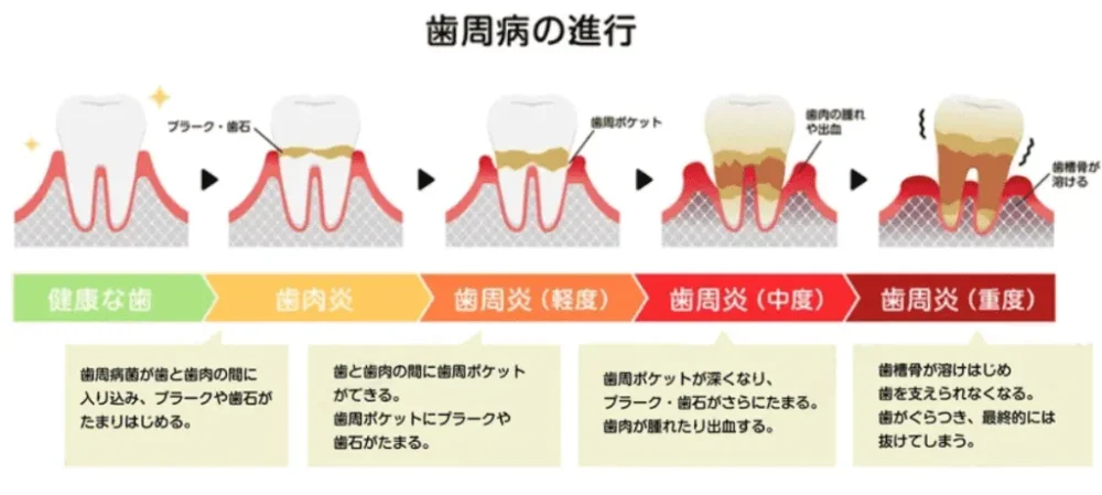 歯周病の進行