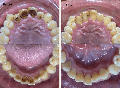 歯のクリーニングの症例