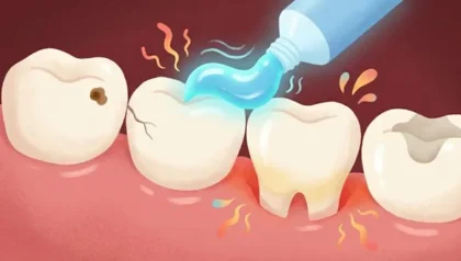 海外のホワイトニング歯磨き粉でしみる歯