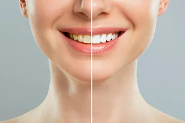 ホワイトニング