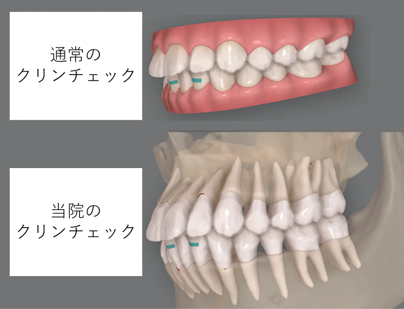 クリンチェックシミュレーションソフト